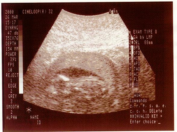 26 March 2001 (14 weeks)